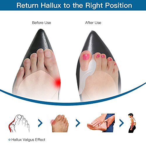 2 Pares Juanete Protector Gel Cojín Pad Alivio del Dolor Hallux Valgus Toe separador de silicona, Enderezador para dedo gordo del pie, corrector de juanetes