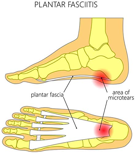 ActivSocks Calcetines de Compresión Graduada | Tratamiento para Fascitis Plantar de Aquiles | Medias Terapéuticas | Ideal por Deportivos e Caminar PAR | (M: EU 41-42)