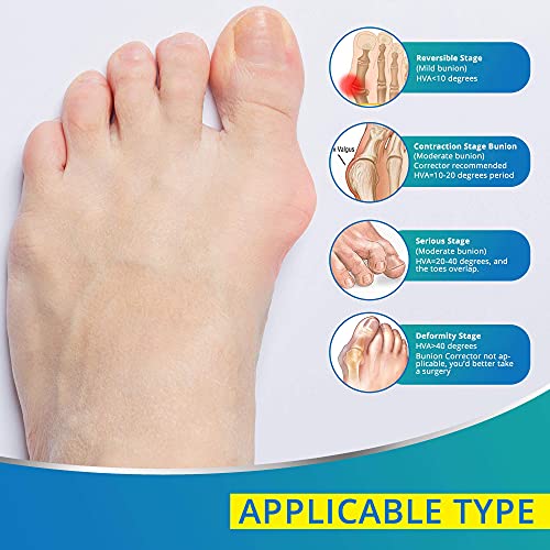 Corrector de hallux y separadores de hallux valgus, férula ortopédica de hallux valgus para aliviar el dolor de hallux y enderezar los dedos de los pies, ortesis de para soporte diurno/nocturno