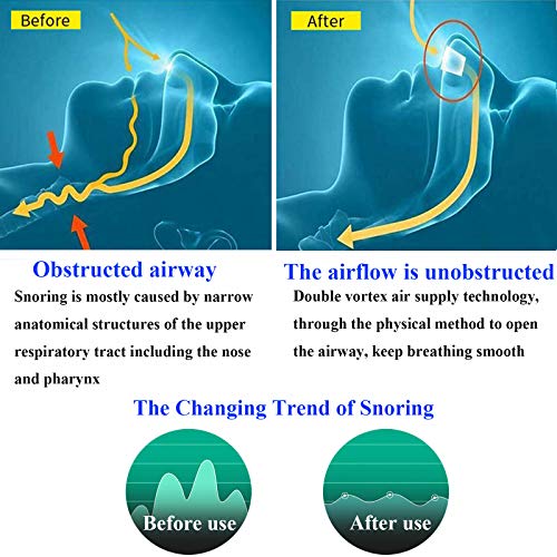 Dispositivos Antirronquidos, Automático Dejar de Roncar, Anti Ronquidos Soluciones, Ronquido TapóN Nariz Respiraderos Ronquido Dilatadores Nasales para Dormir Mejor para Hombres Mujeres