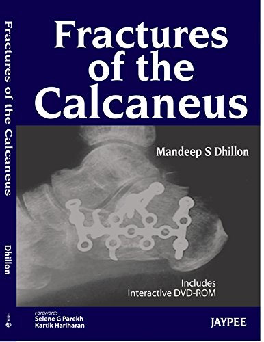 Fractures of the Calcaneus (English Edition)