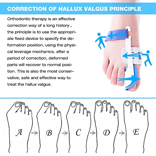 Kemei Férula para juanetes, que proporciona alivio del dolor y corrección, en un juego de 2 unidades, y que incluye almohadillas protectoras para los dedos