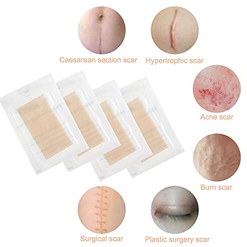 Xnuoyo Parches De Silicona Cicatrices, Silicone Scar Removal Sheets, Parches Para Cicatrices,reduce La Visibilidad De Las Cicatrices Y Haz Que Las Cicatrices Sean Más Planas-4 Piezas