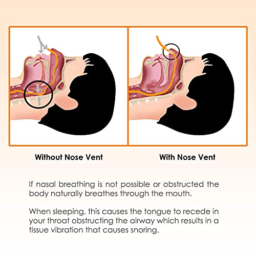 Dilatador nasal Nose Relief - (Paquete de 12 tamaños grandes) Ventilaciones suaves de silicona - Solución sencilla para los que respiran por la nariz - por Mobi Lock Beauty