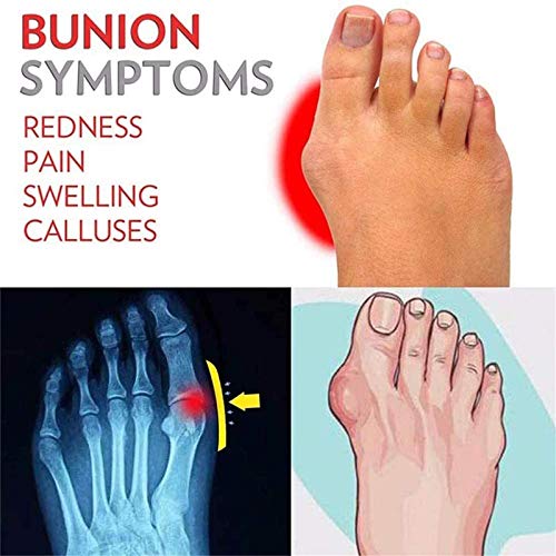 ZHXMYD Sandalias Férulas Mujer Dedo Grande Plano Hallux Valgus Ortopédico para Tratamiento Sandalias De Corrección De Dedo Gordo De Cuero PU Sandalias De Verano con Punta Abierta