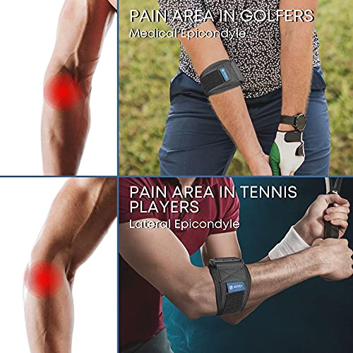 Correa de codo de tenis con almohadilla de compresión, soporte ajustable para codo de tenis y golfistas, epicondilitis lateral y medial.