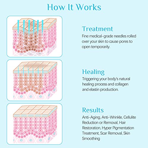 Derma Roller,Aiglam 6 en 1 Dermaroller de Titanio 0.25/0.5/1mm por Ojos, Cara, Cuerpo, Antimanchas, Anti-Edad, Antiarrugas (Blanco)