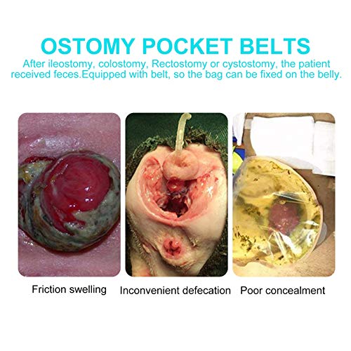 HEALLILY 1 Juego de 100 Unidades de Bolsas de Drenaje de Ostomia Bolsas Desechables de Colostomia Anal Estoma Drenaje para Ajustar La Bolsa de Orina Ileostoma Cuidado Del Estoma con 2