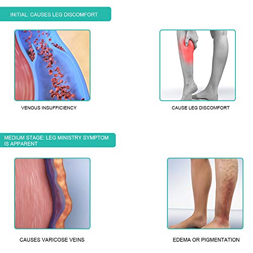 Medias de compresión hasta la rodilla, venas varicosas hasta el muslo con calcetines abiertos para mujeres, hombres, protección de pantorrillas, mangas de compresión para piernas, medias de compresión