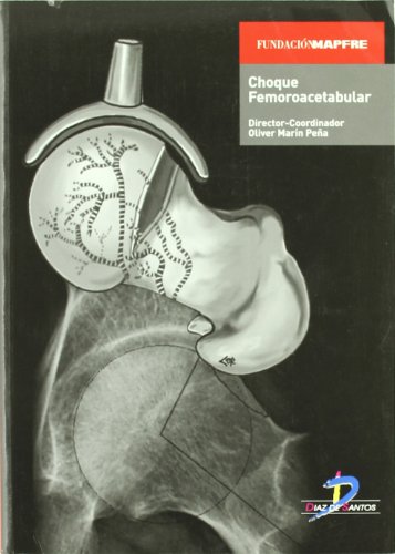 Choque femoroacetabular