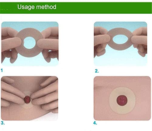 HXSCOO Estoma Anillo a Prueba de Fugas, Productos de Accesorios de Cuidado, Suministros médicos de ostomía, Anillo de Barrera de cinturón de hernios de 4.2 mm de Espesor