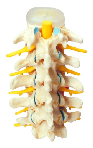 3B Scientific A795 Modelo Anatómico Humano - Estadios del de la Hernia Discal y de la Degeneración Vertebral + Software de Anatomía - 3B Smart Anatomy