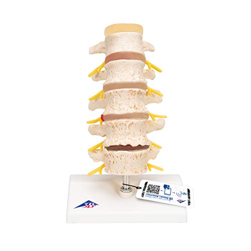 3B Scientific A795 Modelo Anatómico Humano - Estadios del de la Hernia Discal y de la Degeneración Vertebral + Software de Anatomía - 3B Smart Anatomy