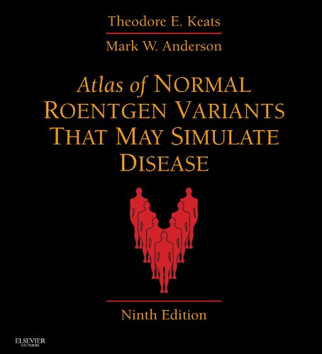 Atlas of Normal Roentgen Variants That May Simulate Disease E-Book: Expert Consult - Enhanced Online Features and Print (English Edition)