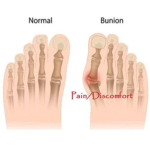 Bunion Pads, Bunion Corrector Toe Protectores Bunion Gel Pad Spandex Bunion Toe Reforzadores Esparcidor con 2 botines 1 par