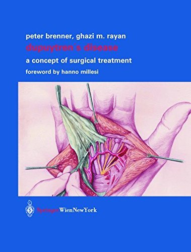 Dupuytren’s Disease: A Concept of Surgical Treatment (English Edition)