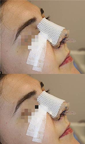 Férulas nasales termoplásticas, protector de apoyo nasal externo para cirugía de rinoplastia, fractura de la nariz, ENT, inmovilización ortopédica (B), 5pcs-M