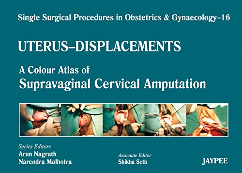 Single Surgical Procedures in Obstetrics and Gynaecology16: A Colour Atlas of Supravaginal Cervical Amputation (Nadkarni's): Single Surg.Proced In Obs&Gyne (English Edition)