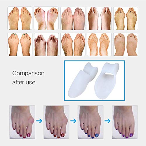 WHBQ Separador Dedos Pie, Corrector De Juanetes para Tratar Y Prevenir Varios Problemas En Los Pies, Hallux Valgus Dedo Martillo1 Set