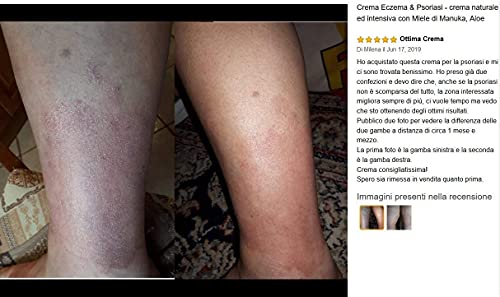 Crema para eccema y psoriasis Natura Only, para pieles secas e irritadas, alivio de picazón, dermatitis, rosácea y culebrilla (fuego de San Antonio).