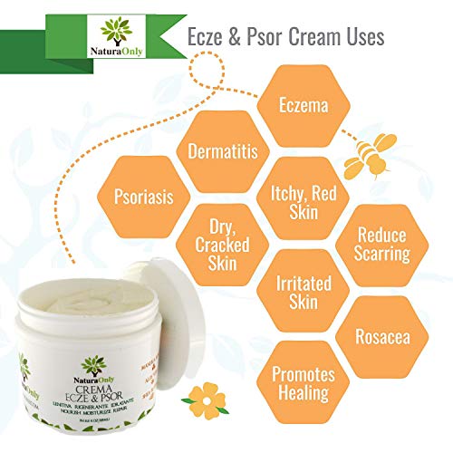 Crema para eccema y psoriasis Natura Only, para pieles secas e irritadas, alivio de picazón, dermatitis, rosácea y culebrilla (fuego de San Antonio).