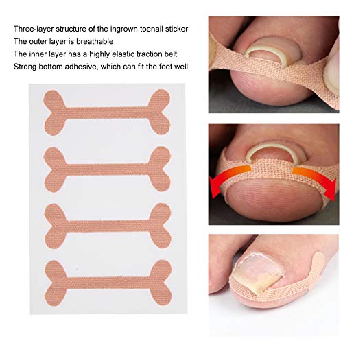 Juego de herramientas de pedicura de 8 piezas, corrector de uñas encarnadas parche autoadhesivo para uñas de los pies parches para uñas encarnadas pegatinas herramienta de cepillado