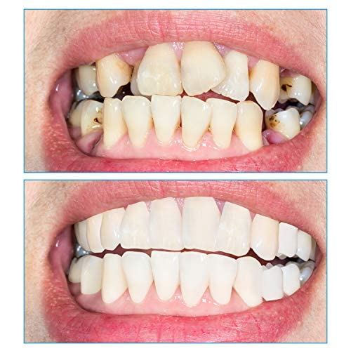 4 Pares Dientes de Carillas Cosméticos Dientes Dentaduras Temporales Instantáneos Dentaduras Comodidad Broche de Presión de Carillas Superiores e Inferiores para Dientes Malos.