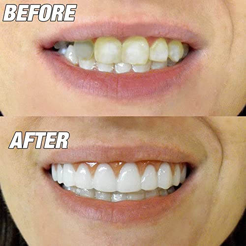 BDBDPPAC 2 Pares Dentaduras Cosméticos Postiza Dientes de Silicona Dental de Carilla Dentadura Instantánea Diente de Prótesis Temporal de Blanquear Diente Falso Superior Inferior