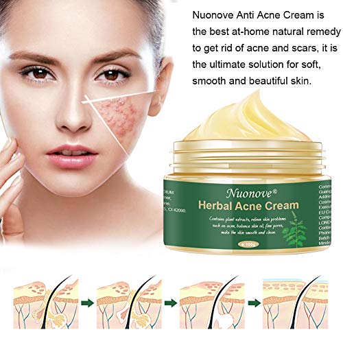 Crema Antiacne, Acné Crema, Anti Acne, Acne Tratamiento, Acne Cream, Reducir los Puntos negros, Equilibrar el Agua y el Aceite, la Crema Contra el Acné Espinilla, Regenera la piel, 100 g