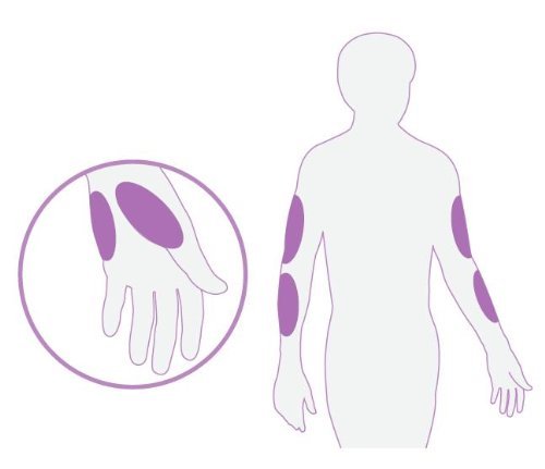 Home Health UK Ltd Dispositivo de Puncion para Toma de muestras de Sangre en diabeticos (Solo Dispositivo)