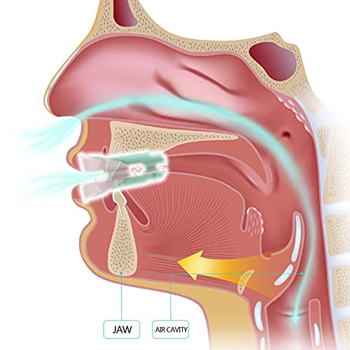 NXM Férula Dental Antirronquidos Solución para La Apnea Antironquidos De Alta Gama Solución para El Ronquido - Dispositivo De Avance Mandibular para Dormir Mejor para Hombres Mujeres