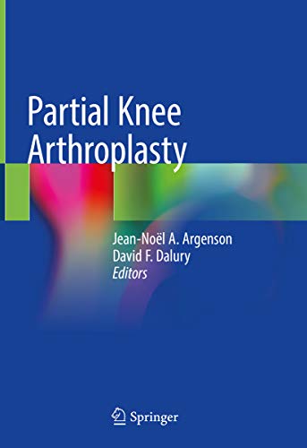 Partial Knee Arthroplasty (English Edition)