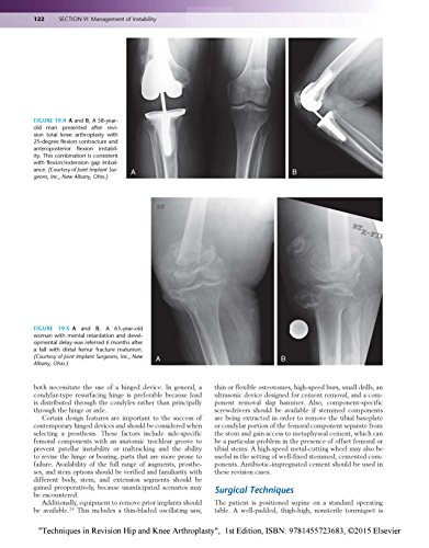 Techniques in Revision Hip and Knee Arthroplasty, 1e