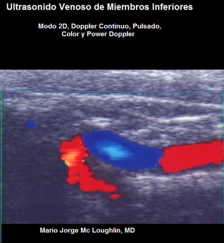 Ultrasonido venoso de miembros inferiores