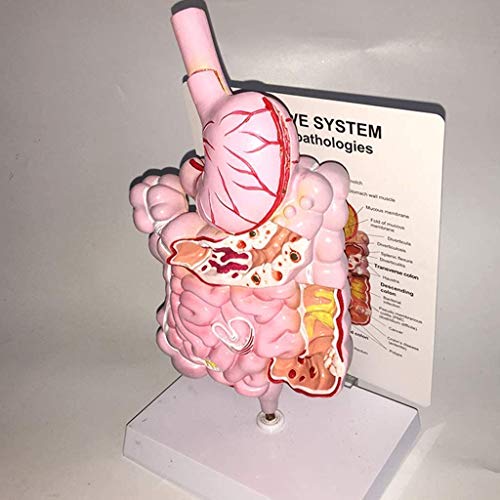 LBYLYH Paradigma Pedagógico Cúbito Úlcera Patológico Patología De Colon Modelo Anatómico - Digestive System Organ Modelo Humano Modelo Humano PVC