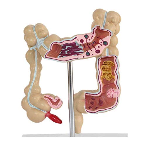 Modelo patológico de colon humano, modelo de lesión colorrectal de colon humano, modelo de enfermedad patológica del intestino grueso, modelo de lesión colorrectal para material didáctico de educació